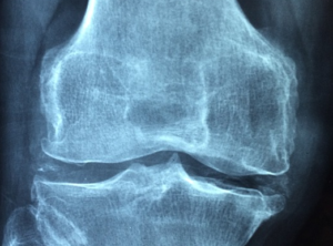 joint xray