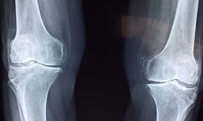 human bones under x-ray